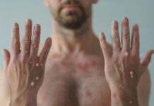 A male hands affected by blistering rash because of monkeypox or other viral infection on white background