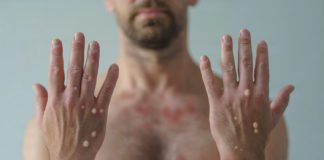 Monkeypox in Pasadena | Public Health Confirms First Cases A male hands affected by blistering rash because of monkeypox or other viral infection on white background