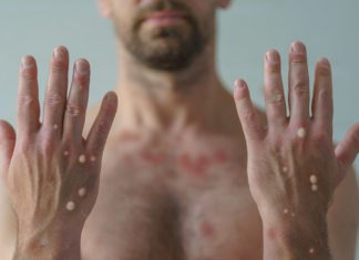 Monkeypox in Pasadena | Public Health Confirms First Cases A male hands affected by blistering rash because of monkeypox or other viral infection on white background